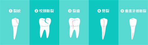 掉下來的牙齒|牙齒斷掉：處理、預防與修復